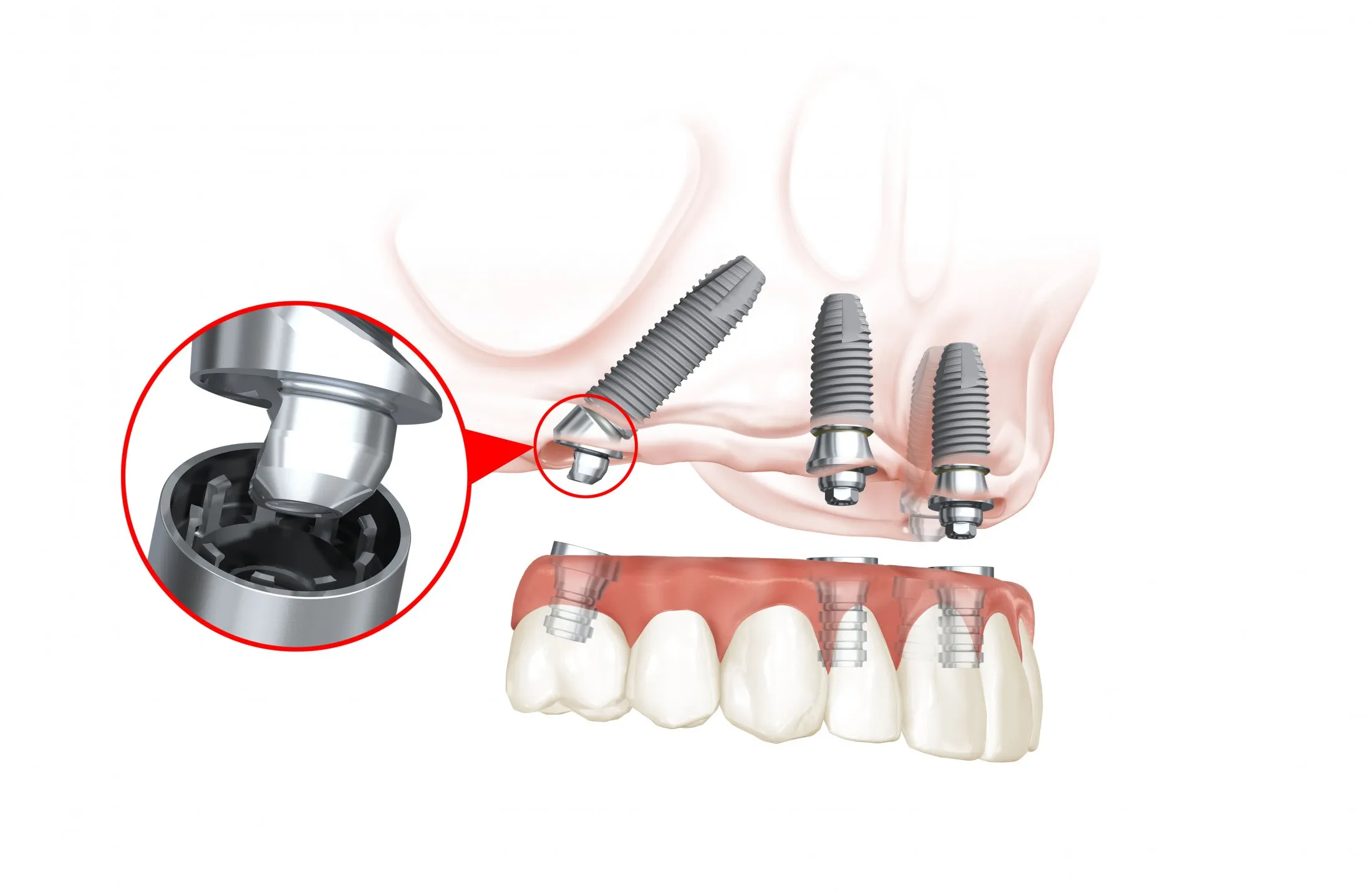 All-on-4® Dental Implants top view