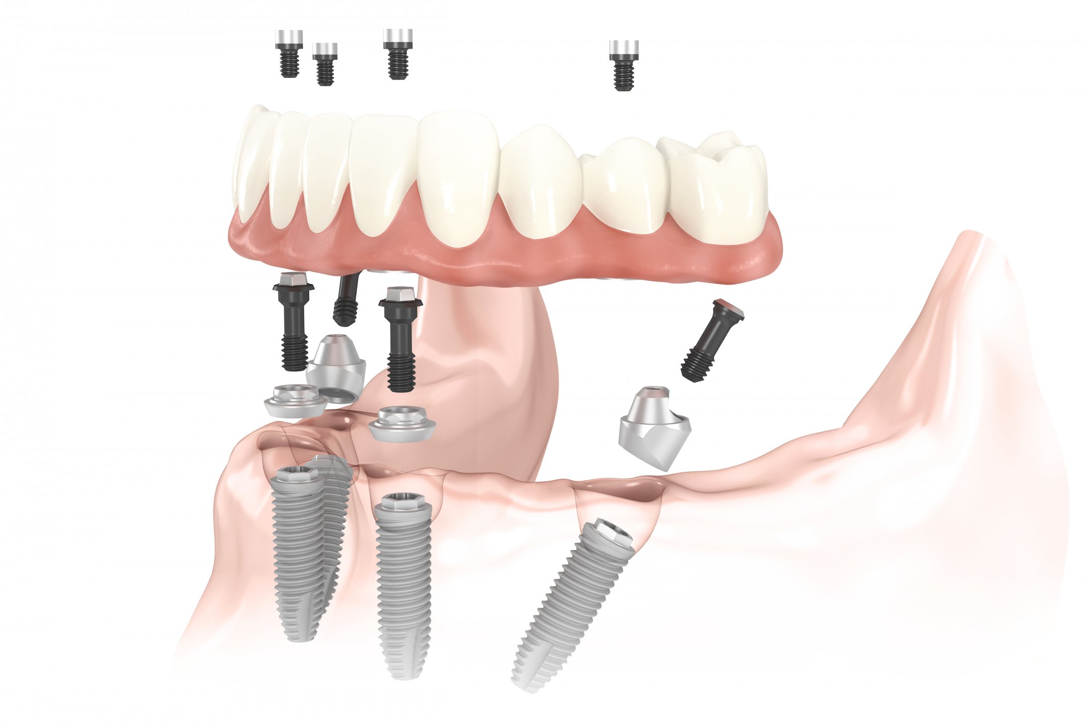 All-on-4® Dental Implants bottom view