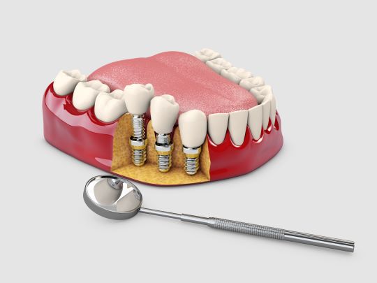 Dental Implants Daly City