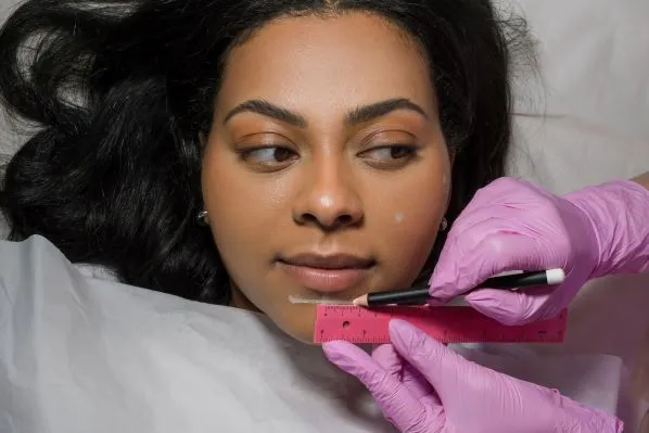 woman getting Juvéderm mapping