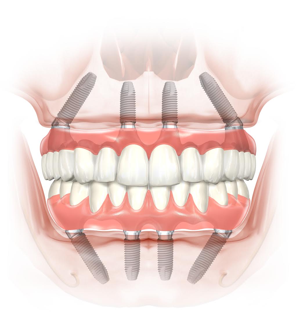 All-on-4® Dental Implants front view