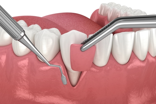 mock up of soft tissue graft