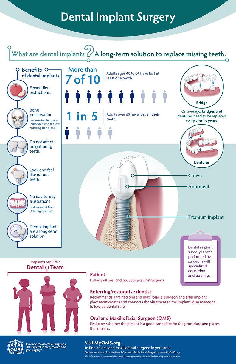 Dental implant surgery at a glance — AAOMS infographic