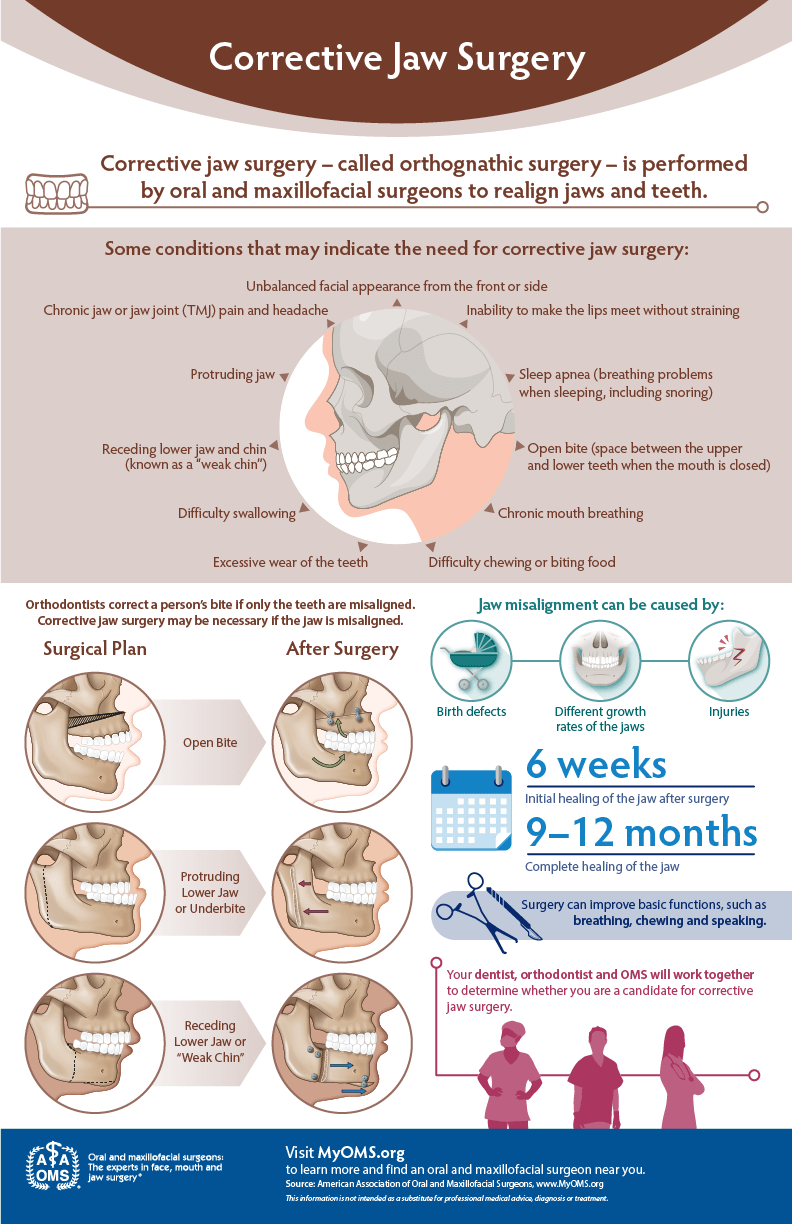 Corrective jaw surgery at a glance — AAOMS infographic
