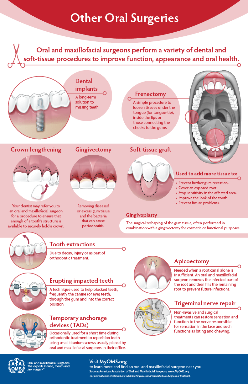 Tooth extractions and other oral surgeries at a glance — AAOMS infographic