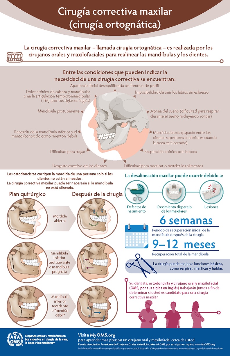 Infografía de la AAOMS: cirugía correctiva de la mandíbula