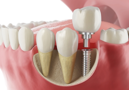 Implants in gums daly city